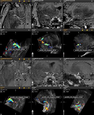 Frontiers Utilizing Intraoperative Navigated 3D Color Doppler